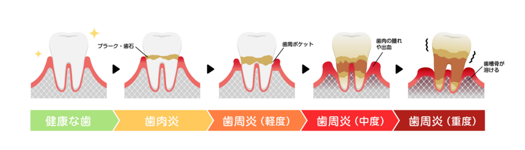 歯周病の進行｜まちの歯科